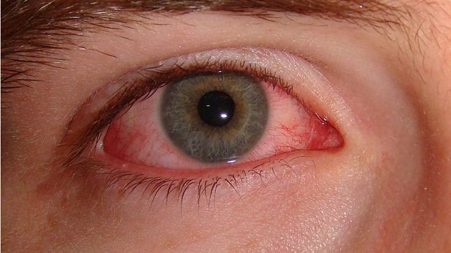 Ojo rojo por uso incorrecto de lentes de contacto